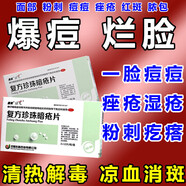祛痘去痘痘痤瘡消炎專(zhuān)用復方珍珠暗瘡片閉口粉刺克星青春痘痤瘡硬疙瘩專(zhuān)用藥去粉刺黑頭臉上去痘痘 【痘痘痤 1盒【科學(xué)祛痘】