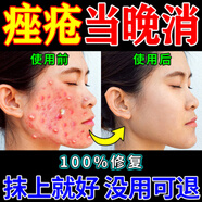 脂溢性皮炎水楊酸壬二酸神經(jīng)酰胺德國(guó)玫瑰痤瘡痤瘡痘痘皮疹瘙癢泛紅修復(fù)面霜 臉玫瑰痤瘡痤瘡痘痘脂溢性皮