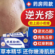 閉口粉刺克星逆光疹臉上起小疙瘩粗糙顆粒感額頭祛痘毛周角化癥 1盒【強力祛痘 溫和護膚】
