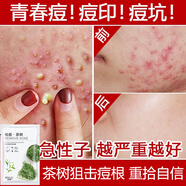 冰菊茶樹凈顏祛痘面膜淡化青春痘痤瘡痘痘貼粉刺痘印補(bǔ)水保濕8片一盒 一盒裝