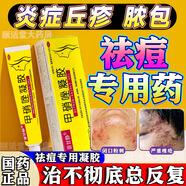 甲硝唑唑凝膠甲硝唑凝膠祛痘消炎痤瘡專用藥痤瘡專用膏特效去青春痘粉刺硬疙瘩粉刺痤瘡痘痘【發(fā)貨特效率】藥 3盒【閉口粉刺 爆發(fā)性痤瘡】