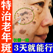 維a酸乳膏去老年斑專用藥一夜消祛斑專用藥去除老年斑的特治療效藥強(qiáng)力祛除手部臉部祛斑效果最好的產(chǎn)品 5盒【深層調(diào)理 快速祛斑】好后可停藥