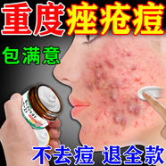 東田祛痘消炎痤瘡專(zhuān)用學(xué)生青少年藥膏硬疙瘩粉刺青春痘印修復(fù)淡化中藥 1盒裝【一抹消痘】 去痘痘和痘印