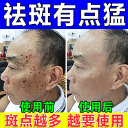 喬記本草祛斑霜美白淡化老年黃褐雀斑黑色素去斑專用醫(yī)用正品手背臉部美白 1盒【醫(yī)用正品】