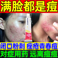 痘痘修復(fù)消炎痘印閉口粉刺痤瘡專用膏特藥效去青春痘粉刺硬疙瘩毛囊炎祛痘印青少年學(xué)生淡化痘印維A酸乳膏 5盒裝【反復(fù)長痘 痘印嚴重痘印痘坑痘疤 難以祛除