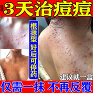 祛痘消炎痤瘡專(zhuān)用青少年除螨蟲(chóng)皮膚用藥背后長(zhǎng)痘痘藥膏毛囊炎頭癬粉刺痤瘡痘痘特有效藥硬疙瘩克霉唑乳膏 5盒【頑固痘痘消不掉 反復(fù)長(zhǎng)】一次買(mǎi)對(duì) 告別痘痘