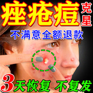 喬記本草醫(yī)用祛痘消炎痤瘡專用青少年[藥監(jiān)備案]面膜硬疙瘩粉刺淡化痘印 痤瘡青春痘印專用面膜【好后管一生】 祛痘消炎痤瘡專用面膜
