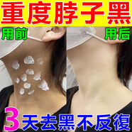 脖子黑色素沉淀去除治黑棘皮癥藥膏男女胖胳膊肘腋下去黑色素神器 3盒【全網(wǎng)熱銷(xiāo)10w+】醫(yī)美推薦