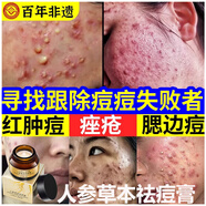 澳芙雪人參草本祛痘膏淡化青春痘霜凝膠正品粉刺痘坑痘印痤瘡專用 一瓶裝