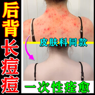 正精研康后背祛痘藥膏前胸后背部毛囊炎長痘痘瘙癢專用治膿包痤瘡真菌感染 買5送3【油脂分泌多】告別背后痘 成分溫和