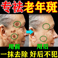 碧素堂祛斑霜美白淡化老年黃褐雀斑去斑去黑色素男士老年斑臉部手背祛斑 強效特效:買三送二【好后不犯】 專用霜去老人斑淡化淡斑醫(yī)用正品