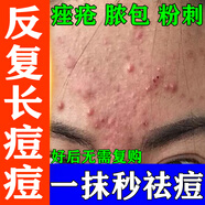 祛痘藥膏痘痘特正效藥青春痘祛痘膏祛痘消炎痤瘡專(zhuān)用青少年學(xué)生祛痘淡化痘印皮膚用藥非處方藥克霉唑乳膏 5盒【頑固痘痘消不掉 反復長(cháng)】一次買(mǎi)對 告別痘痘
