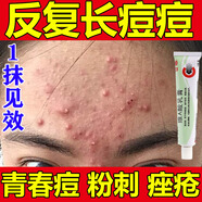 維A酸乳膏祛痘藥膏痘痘特有效藥修復消炎痘印痘坑淡化去痘痤瘡專(zhuān)用的藥膏學(xué)生青春痘醫用皮膚用藥 非處方藥 1盒【國藥OTC 藥房直發(fā)】