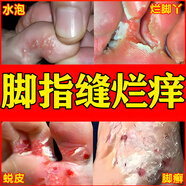 硝酸咪康唑乳膏腳氣藥止癢脫皮爛腳丫真菌感染根部治腳氣 腳氣去部根專用（發(fā)貨特效率）藥腳氣軟膏 1盒裝【建議多盒裝】
