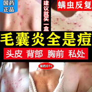 克霉唑乳膏噴霧毛囊炎藥膏后背除螨蟲的藥疙瘩止癢殺菌抗真菌感染皮膚用藥頭部膿皰瘡祛痘消炎痤瘡青少年專用 1盒正品醫(yī)用級痘痘馬拉色菌后背部前胸癬祛圖視覺特效