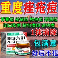 東田祛痘消炎痤瘡專用學(xué)生青少年藥膏硬疙瘩粉刺青春痘印修復(fù)淡化中藥 1盒裝【一抹消痘】 去痘痘和痘印