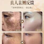柔迪脫皮美白祛斑霜黃褐斑雀老年斑強(qiáng)力去除黑色素 1白1黃[早晚]美白祛斑