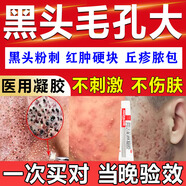 阿達(dá)帕林凝膠改善毛孔粗大醫(yī)用祛痘消炎痤瘡專用膏藥青少年去淡化看看痘印黑色素沉淀收縮痘痘修復(fù)閉口粉刺 2盒【夏天油脂分泌旺盛 毛孔粗大】細(xì)致去黑頭