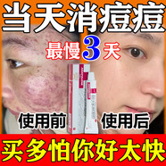 阿達帕林凝膠醫用祛痘消炎痤瘡專(zhuān)用青少年祛痘藥膏痤瘡硬疙瘩專(zhuān)用藥改善臉上紅腫硬塊青春痘痘印修復毛孔粗大 5盒【告別頑固痘痘】是祛痘不是淡痘