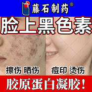 藤石制藥炎癥后臉上黑斑點(diǎn)黑色素可搭去除臉部排毒排黑色素黑色素沉淀面部去斑去黑色素臉部醫用色素下暗沉膏使用N3 2盒 白愈康膏送棉簽【第二盒半價(jià)】臉上黑色素黑斑印