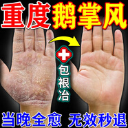 千草本原鵝掌風(fēng)專(zhuān)用的藥手癬真菌感染嚴重脫皮干裂手粗糙變厚止癢抑菌藥膏 特效 買(mǎi)3送2【告別鵝掌風(fēng)】