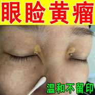 眼瞼黃瘤專(zhuān)用去除眼角黃疣眼角黃斑瘤眼部脂肪粒汗管瘤專(zhuān)用眼膏zy 買(mǎi)二送一（療程裝）