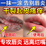 日本進(jìn)口技術(shù)唇炎專(zhuān)用修復藥100%慢性嘴唇干裂上火醫用潤唇膏兒童 買(mǎi)五送四【拒絕唇炎 深層修復】