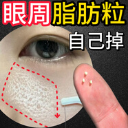 示博士脂肪粒去除藥膏汗管粒油脂粒去除神器眼周小白粒專用去小顆粒眼霜 1瓶【無優(yōu)惠】