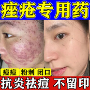 祛痘消炎痤瘡專(zhuān)用青少年 醫用痤瘡中藥去青春痘粉刺紅腫硬疙瘩痘印祛痘痘膿皰瘡去痘印 復方珍珠暗瘡片 2盒【日常粉刺痘痘】中藥內調