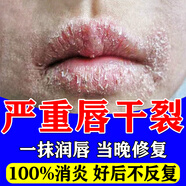 山本中村制薬唇炎專(zhuān)用膏藥慢性嘴唇干裂醫用級脫皮慢性口唇炎唇膏口角反復開(kāi)裂 買(mǎi)5送3【拒絕爛嘴--必治根】