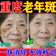 珀美博士 DR.BORMELL美白淡斑祛斑霜正品淡化黑色素去雀斑黃褐斑雀斑曬斑女士專(zhuān)用的藥 特效單盒【祛斑霜老年斑一夜消】 醫用祛斑霜效果最好的產(chǎn)品去老年斑強力祛除手部臉部