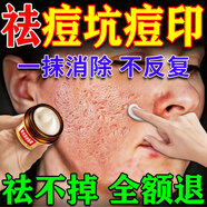 廣雅祛痘印黑色素沉淀藥膏修復淡化消除痘印痘坑凹洞男女士醫(yī)用精華液 一盒裝【快速祛除】 去痘痘和痘印