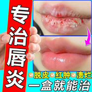 資生堂唇炎唇膏唇炎專用藥慢性嘴唇干裂醫(yī)用級(jí)紅霉素軟膏抗菌感染消炎唇炎專用醫(yī)用級(jí)唇炎膏嘴唇干裂脫皮專用 1盒裝【國(guó)藥準(zhǔn)字 正品保障】