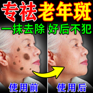 東田老年斑專(zhuān)用的膏藥一夜消臉部手背祛斑專(zhuān)用霜去老人斑強力除男士液 【1盒裝】特效膏 美白祛斑霜淡化黑色素黃褐斑雀斑曬斑女士用的中藥
