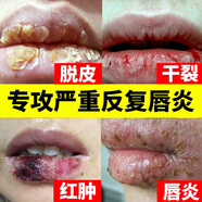 伊思韓香港中西大藥房唇炎膏防干裂保濕補水口角干裂去死皮起皮修復唇膏 5盒裝