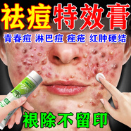 南京同仁堂祛痘消炎痤瘡專用膏藥貼去痘印去閉i口粉刺去黑頭痘坑青春期學(xué)生 特效一盒【蘆薈祛痘膏】 蘆薈膠祛痘痘印淡化疤痕閉口粉刺克星祛痘消炎毛孔堵塞
