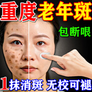 碧素堂祛斑霜老年斑專(zhuān)用特效非藥一夜消強力祛除手部臉部男女祛斑專(zhuān)用霜 買(mǎi)三送二 祛斑效果最好的產(chǎn)品