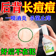 毛囊炎專(zhuān)用特癥效藥后背毛囊炎背上長(cháng)痘痘背部除螨祛痘藥專(zhuān)用除背痘頭部前胸膿包馬拉色菌鹽酸特比萘芬噴霧劑 5盒【告別毛囊炎】好后可停用