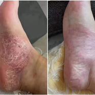 腳癬一次凈500ml一瓶 明星專(zhuān)利產(chǎn)品詳情咨詢(xún)客服 500ml一瓶