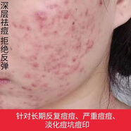 佰草集【官方店鋪】基茵壹號祛痘膏醫用青春痘額頭閉口粉刺淡化痘印坑修 祛痘膏+粉刺露(去痘組合)