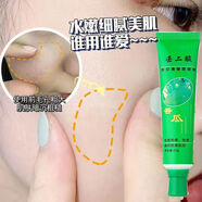 露蘭姬娜（ROLANJONA）金蘆薈痘膠膏消痘去粉刺青春痘男女學(xué)生祛痘收縮毛孔面霜正品 老牌祛痘膏一盒+粉刺針 60g 20年老牌子丨80丨90丨00后都用過(guò)