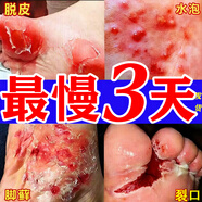 [嘉效]醋酸曲安奈德益康唑乳膏 腳氣止癢脫皮爛腳丫真菌感染根藥治爛腳丫藥腳趾縫爛癢腳臭腳氣專(zhuān)用特新效 1盒【腳氣藥真菌感染脫皮干裂爛腳丫】建議組合裝