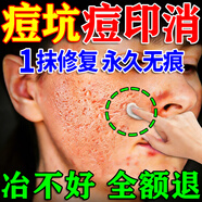 廣雅痘印痘坑修復凹洞男女士臉部收縮毛孔消除淡化痘印祛痘坑精華膏藥 一盒【專(zhuān)業(yè)去痘坑神器】 痘坑專(zhuān)用填充再生凝膠生長(cháng)因子祛痘印修復淡化痘印醫用