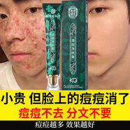 同仁堂祛痘膏去痘痘和痘印痘坑修復男女士改善粉刺閉口30g