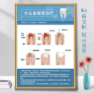 語(yǔ)森憶口腔診所掛畫(huà)牙科診室宣傳海報口腔科掛圖墻面裝飾畫(huà)種植牙 Y13什么是根管治療 PP膠海報貼紙無(wú)框(注意無(wú)厚度) 單張 60x80厘米