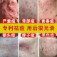 德德維芙脖子上有痘痘青春期痘痘男孩女孩后背上去痘痘臉上長疙瘩閉口粉刺 二盒