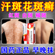 汗斑專用藥 汗斑花斑癬除平方根藥膏成人兒童汗斑白斑花斑糠疹體癬根真菌感染 曲安奈德益康唑乳膏 一盒裝【真菌感染】