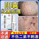 藥健百瑞陰囊血管角化瘤私處紅黑疙瘩睪丸血管痣蜘蛛痣血泡男人角皮用專藥 買二送一三盒裝