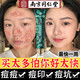 同仁堂祛痘膏祛痘印修復(fù)淡化痘印痘坑修復(fù)男女士青春痘粉刺去痘痘和痘印 一支裝【根源祛痘不反彈】