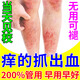 香港大藥房癢的抓出血紅疹皮膚干燥止癢藥膏小腿皮膚瘙癢身體癢爐甘石抑菌膏 1盒裝【多買多送】殺菌消炎膏 換季皮膚劇烈瘙癢長疙瘩